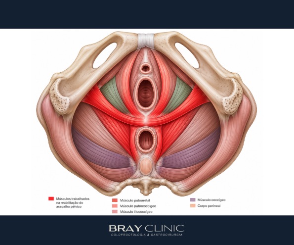 Sensação de "bola" na vagina ou no ânus ao evacuar? Saiba o que é retocele