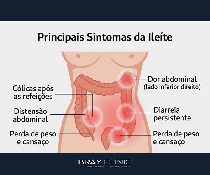 Ileíte: entenda a inflamação do íleo e saiba o que fazer após o diagnóstico