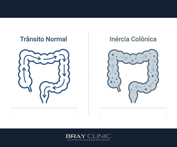 Como tratar a inércia colônica e devolver o movimento ao intestino