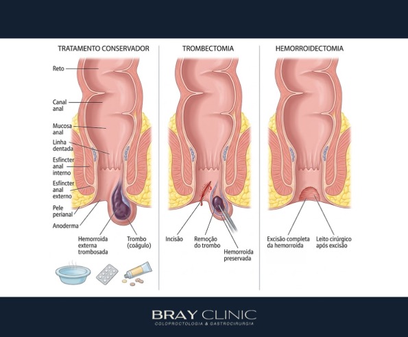 Como tratar a trombose das hemorróidas: do alívio imediato à cirurgia