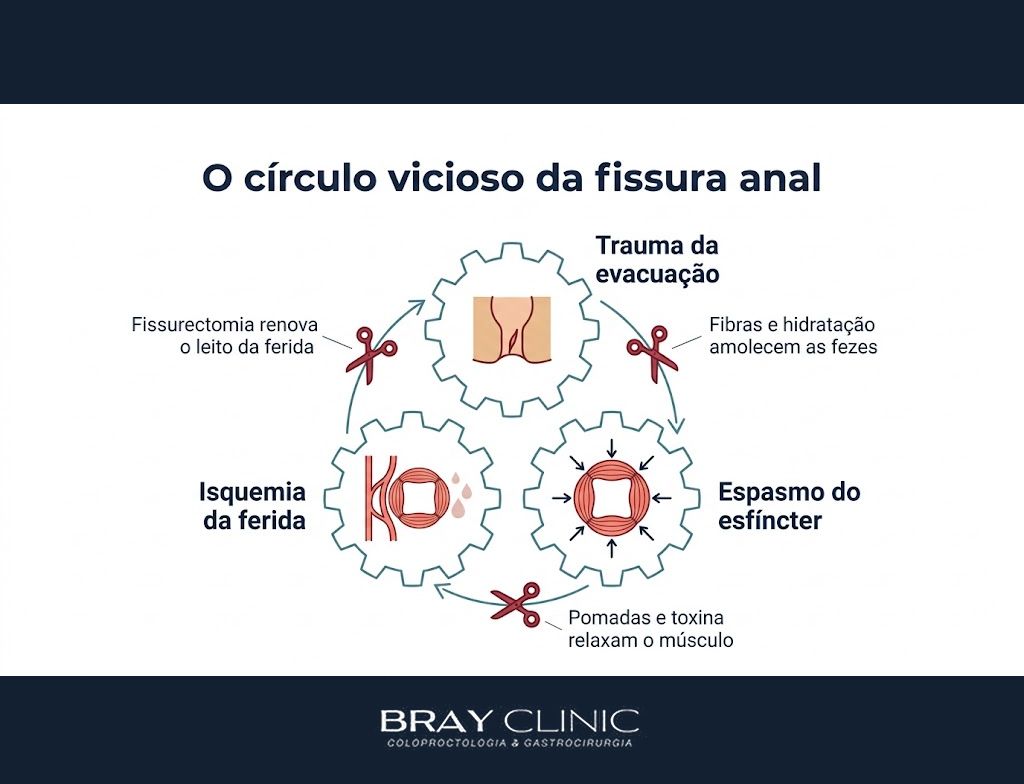 Fissura anal crônica, como quebrar o ciclo da dor sem arriscar a continência