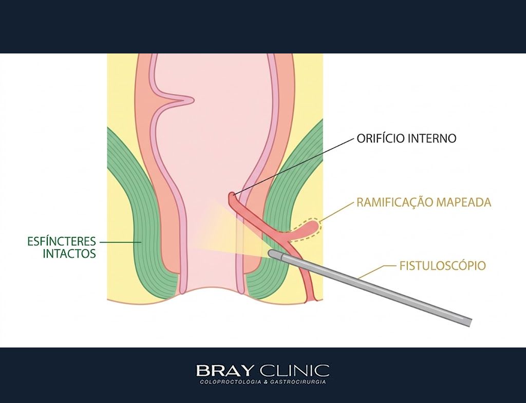 VAAFT, a cirurgia que trata a fístula anal por dentro e preserva a continência