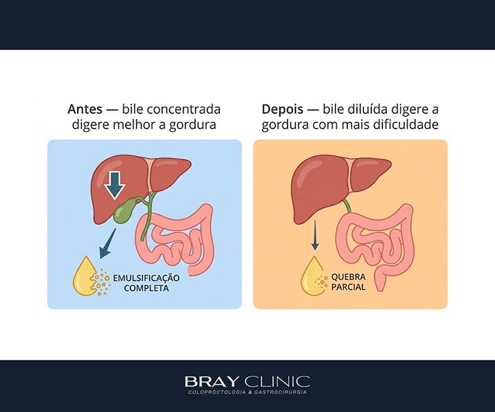 Alimentação pós retirada da vesícula: como adaptar a dieta para viver bem