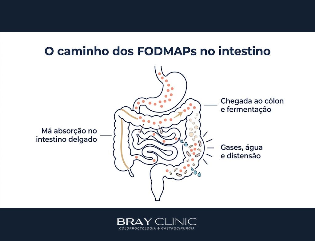 Dieta FODMAP na prática, o protocolo em 3 fases que alivia o intestino irritável